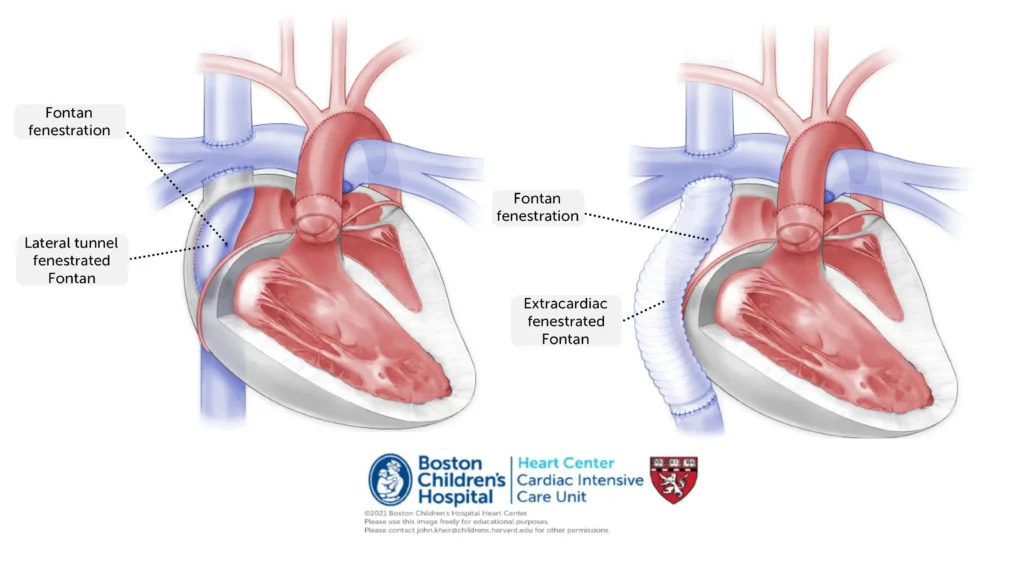 Fontan Procedure