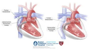 Fontan Procedure